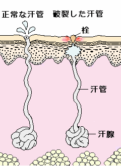 あせもの原因
